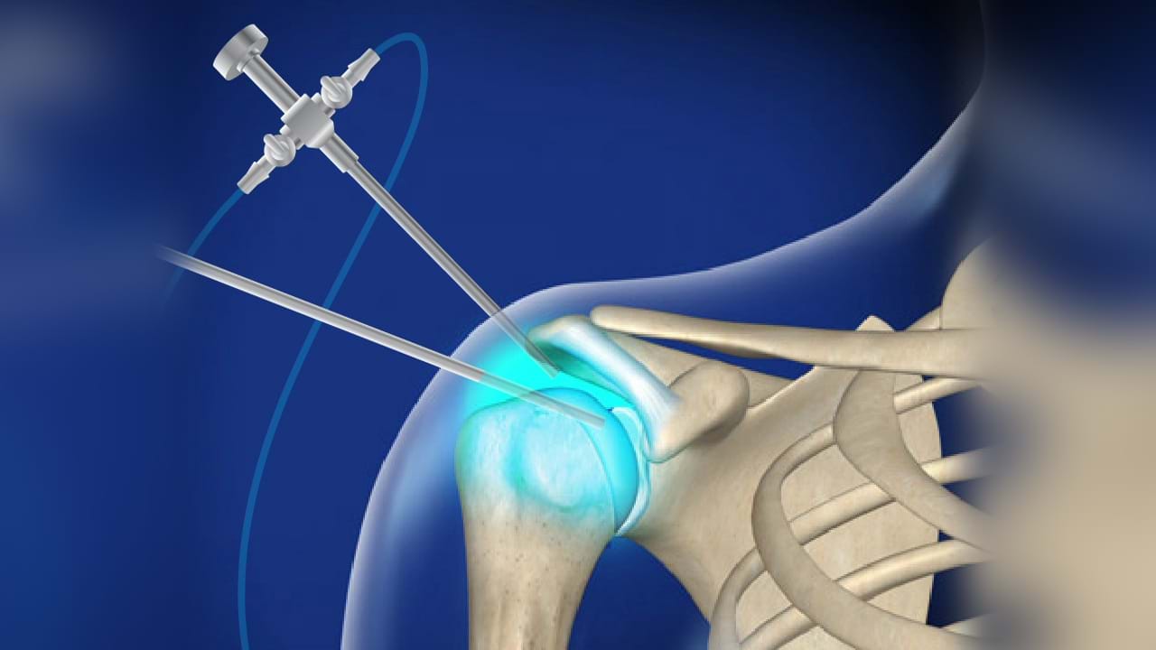 Shoulder Arthroscopy
